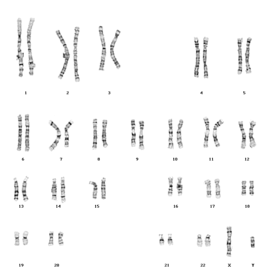 cariotipo con deleción en cromosoma 7