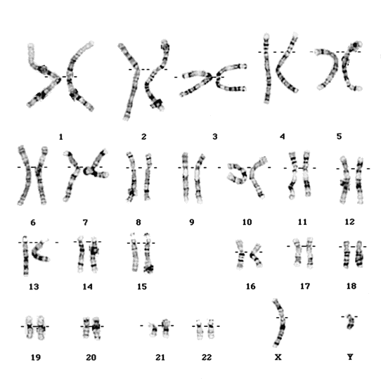 cariotipo inversión del cromosoma 10