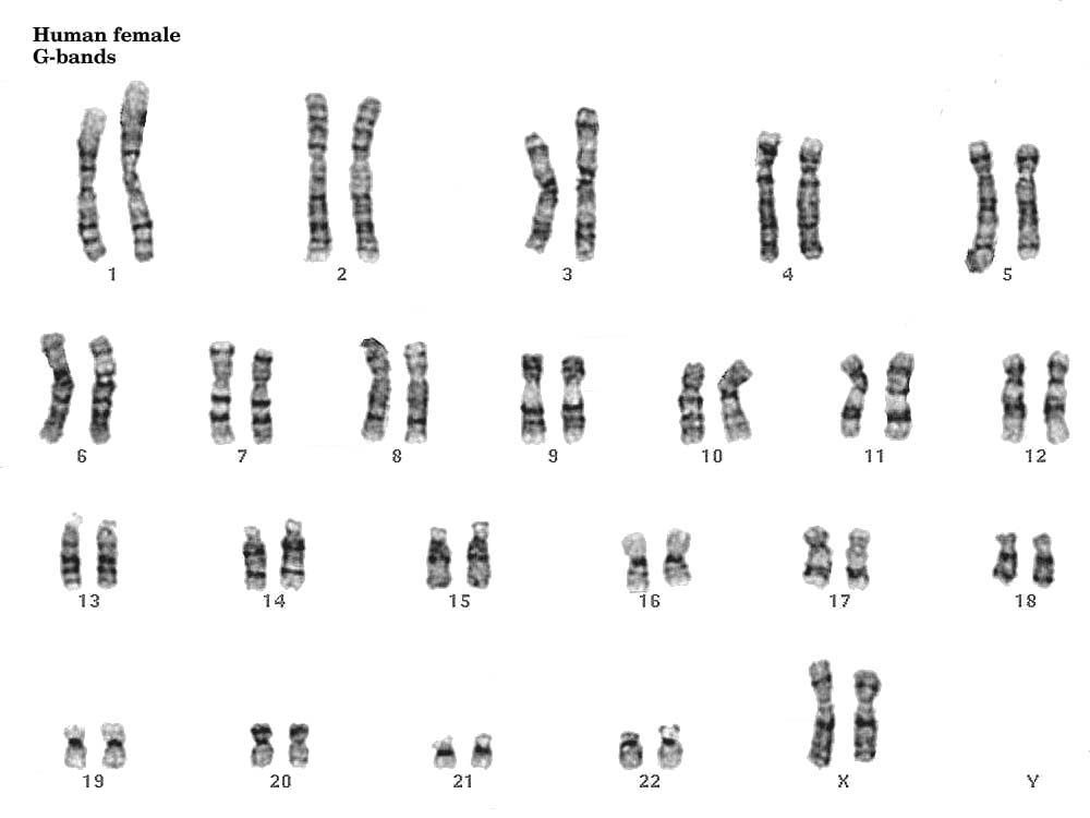 cromosoma 18