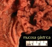 mucosa gástrica